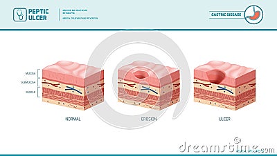 Stomach erosion and peptic ulcer Vector Illustration