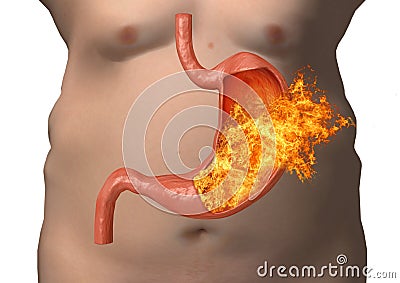 Stomach fire. excessive acidity, indigestion, stomach disease, gastric ulcer, severe abdominal pain Stock Photo