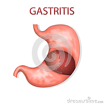 Stomach, gastritis Vector Illustration