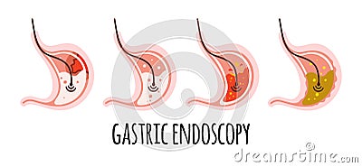 The stomach of a healthy person, with ulcers, gastritis, acidity. Gastroenterology. Vector illustration in a flat style. Vector Illustration