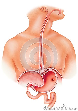 Stomach - Peptic Ulcer Stock Photo