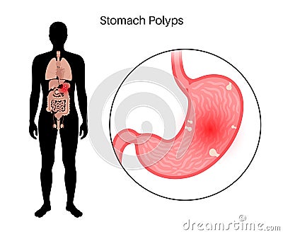 Stomach polyp disease Vector Illustration