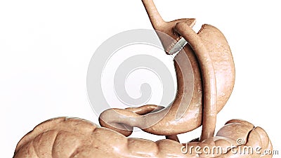 Stomach reduction 2 of 4- Roux en Y Gastric Bypass - 3D Rendering Stock Photo