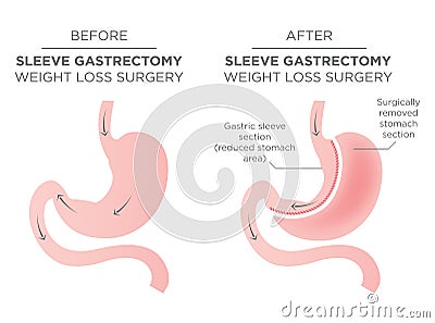 Stomach Staple Bariatric Surgery Vector Illustration