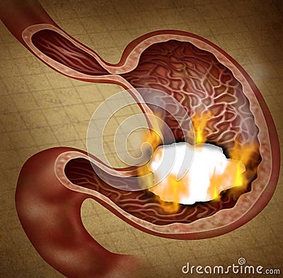 Stomach Ulcer Cartoon Illustration