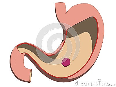 Stomach ulcer Vector Illustration