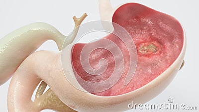 Stomach ulcer - high degree of detail - 3D Rendering Stock Photo
