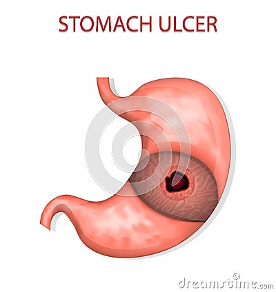 Stomach ulcer Vector Illustration