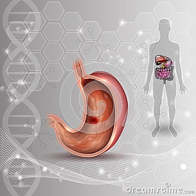 Stomach ulcer Vector Illustration