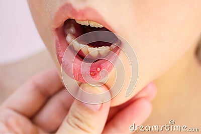 Stomatitis on the lip in child Stock Photo