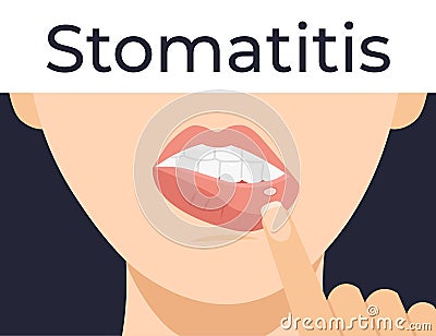 Stomatitis woman lips Vector Illustration