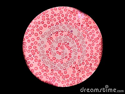 Stomatocytes in peripheral blood. Blood smear -Hematology. Stock Photo