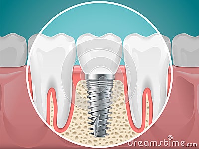 Stomatology illustrations. Dental implants and healthy teeth Vector Illustration