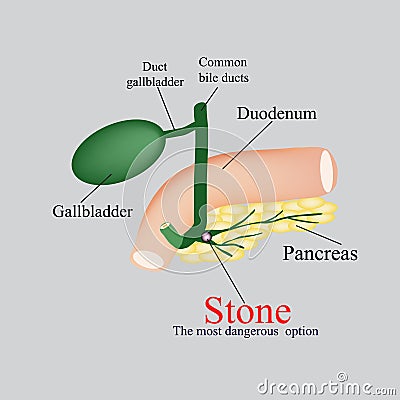 Stone pancreatic bile duct. The gall bladder, duodenum, bile ducts. Vector illustration on a gray background Vector Illustration