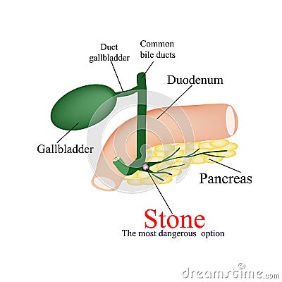 Stone pancreatic bile duct. The most dangerous Vector Illustration