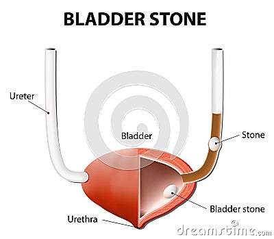 Stones in the urinary bladder and ureter Vector Illustration