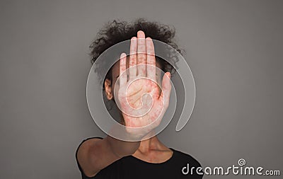 Stop Measles Virus. African Woman With Red Spots On Palm Stock Photo