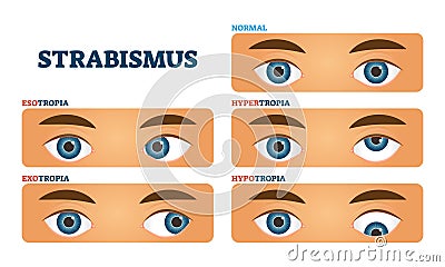 Strabismus or cross eyed vision condition, vector illustrations Vector Illustration