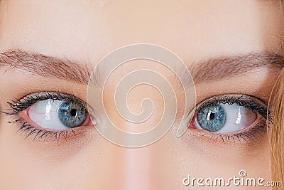 Strabismus Eye Surgery. Close up of crazy female eyes with squint. Eye muscle recession. Extraocular Muscle Anatomy. Stock Photo