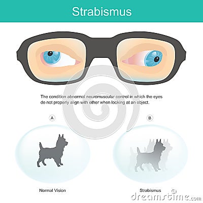 Strabismus. Meaning the condition abnormal neuromuscular control in which the eyes do not properly align with other when looking Vector Illustration