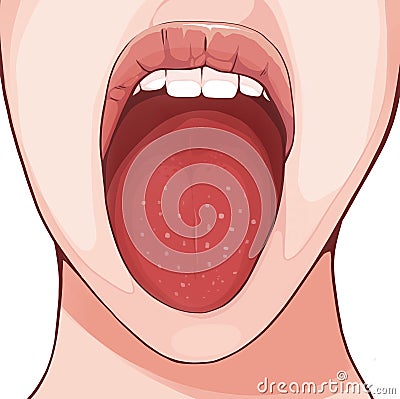 Strawberry tongue is a characteristic of scarlet fever Cartoon Illustration