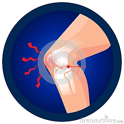 ACL injury of knee icon. Vector flat design for radiology orthopedic research hospital for body joints, Vector Illustration