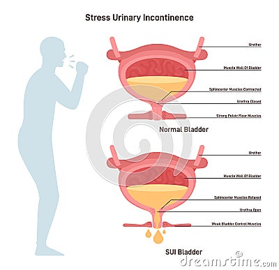 Stress urinary incontinence. Leakage of urine during moments of physical Vector Illustration