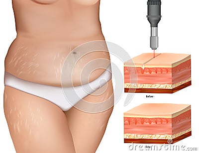 Stretch Mark Removal. Striae or striae distensae. Laser Treatments. Resurfacing, microneedling. Vector Illustration