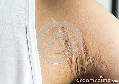 Stretch marks on armpit skin area caused by tearing of the dermis layer of the skin prednisolone`s side effect Stock Photo