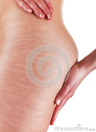 Stretch marks and cellulite Stock Photo