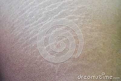 Stretch Marks Stock Photo