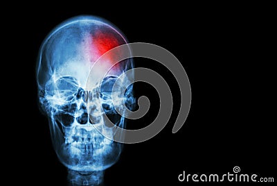 Stroke ( Cerebrovascular accident ) . film x-ray skull of human with red area ( Medical , Science and Healthcare concept and backg Stock Photo