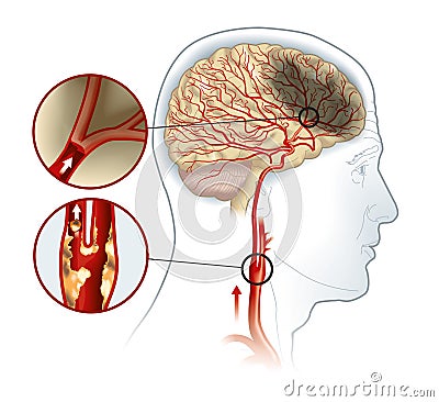 Stroke, medically accurate illustration Stock Photo