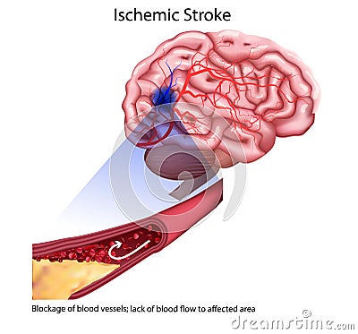 Stroke types poster, banner. Vector medical illustration. white background, anatomy image of damaged human brain Vector Illustration