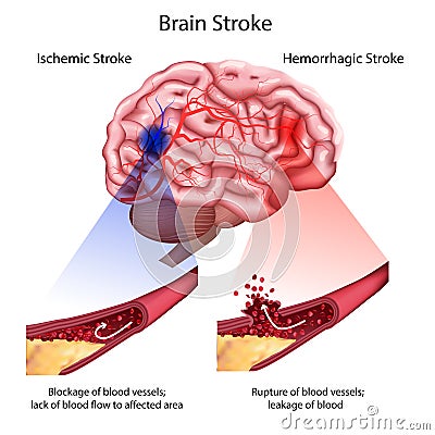 Stroke types poster, banner. Vector medical illustration. white background, anatomy image of damaged human brain Vector Illustration