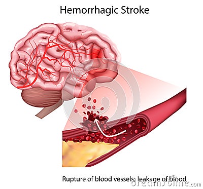 Stroke types poster, banner. Vector medical illustration. white background, anatomy image of damaged human brain Vector Illustration