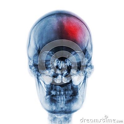 Stroke & x28; Cerebrovascular accident & x29; . Film x-ray skull of human with red area . Front view Stock Photo