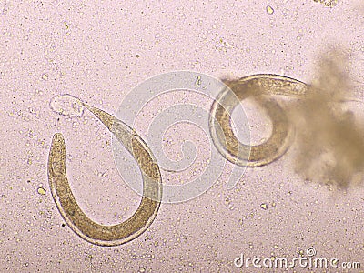 Strongyloides stercoralis or threadworm in human stool Stock Photo