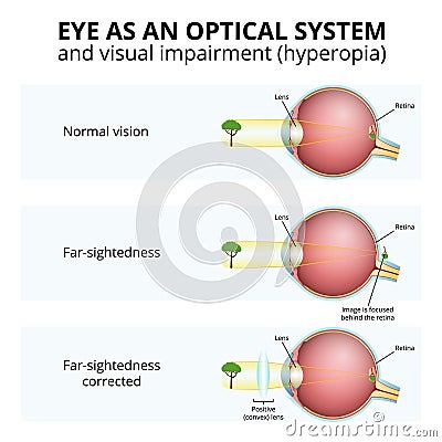 structure of the eyeball, visual impairment, farsightedness Vector Illustration