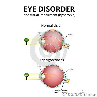 structure of the eyeball, visual impairment, farsightedness Vector Illustration