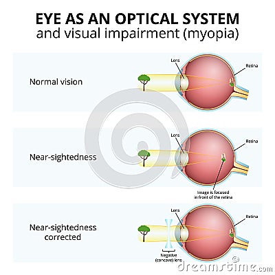 structure of the eyeball, visual impairment, near-sightedness Vector Illustration