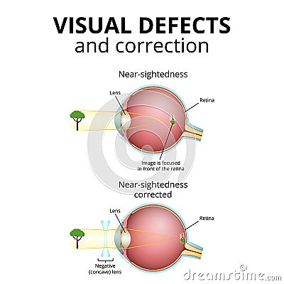 structure of the eyeball, visual impairment, near-sightedness Vector Illustration