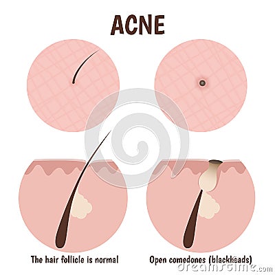 Structure of the hair follicle Vector Illustration