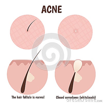 Structure of the hair follicle Vector Illustration