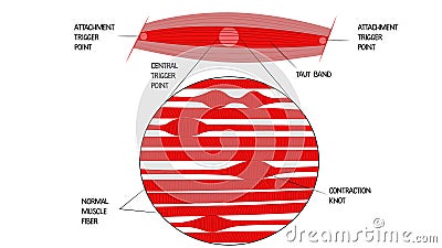 The structure of the trigger point in the muscle. Attachment trigger point. Taut Band. Contraction knot. Normal muscle Stock Photo