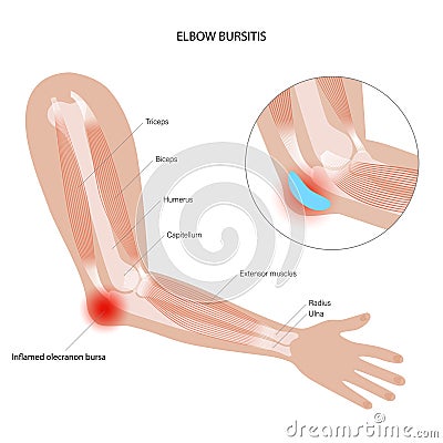 Student elbow bursitis Vector Illustration