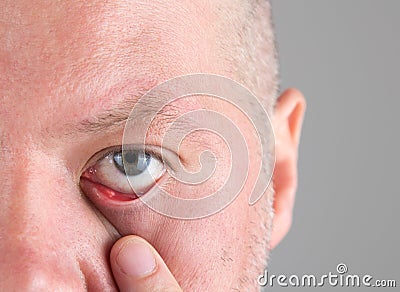 Stye in the eye Stock Photo