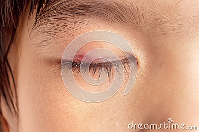 Stye eye infection Stock Photo