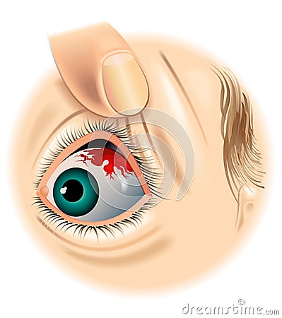 Subconjunctival hemorrhage Cartoon Illustration