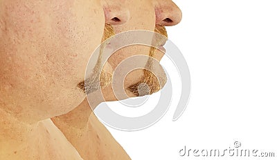 Submental fat man before and after, procedures Stock Photo